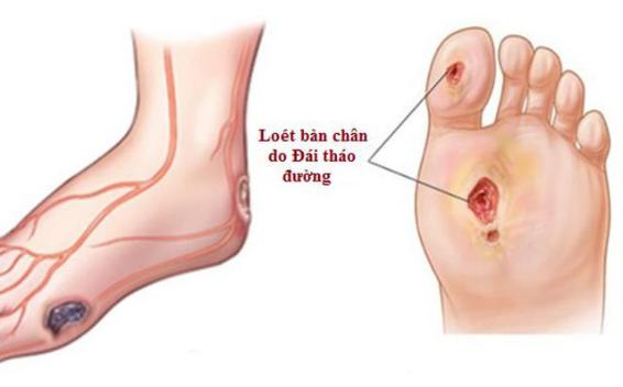 Loét bàn chân bệnh nhân đái tháo đường những điều cần quan tâm